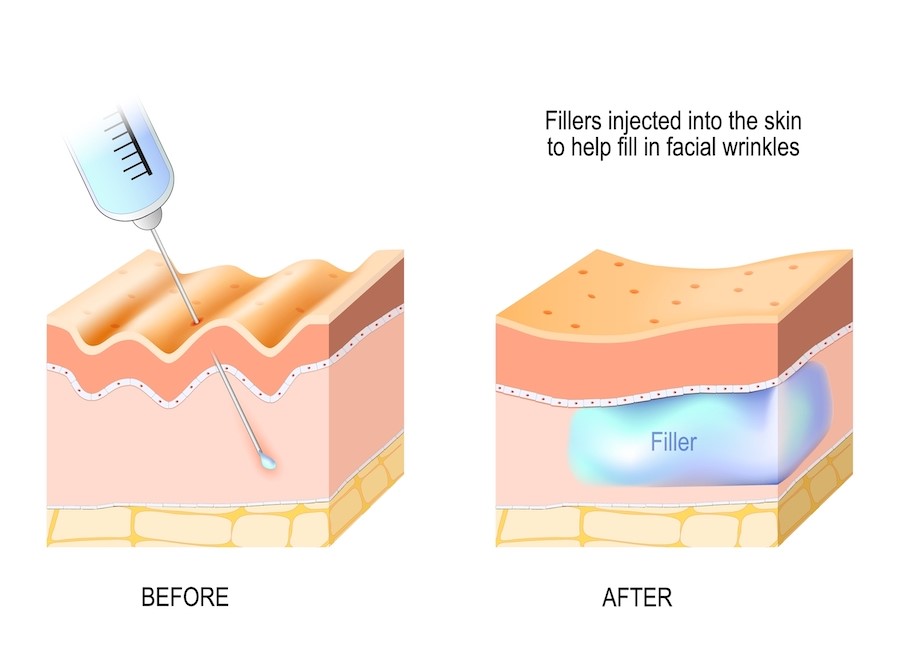 Dermal Fillers